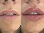 Увеличение губ, контурная пластика лица, Мезотерапия - фото 1