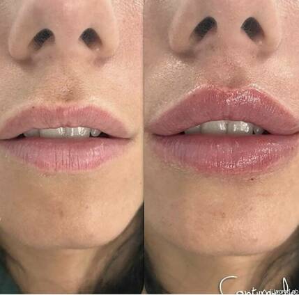 Увеличение губ, контурная пластика лица, Мезотерапия